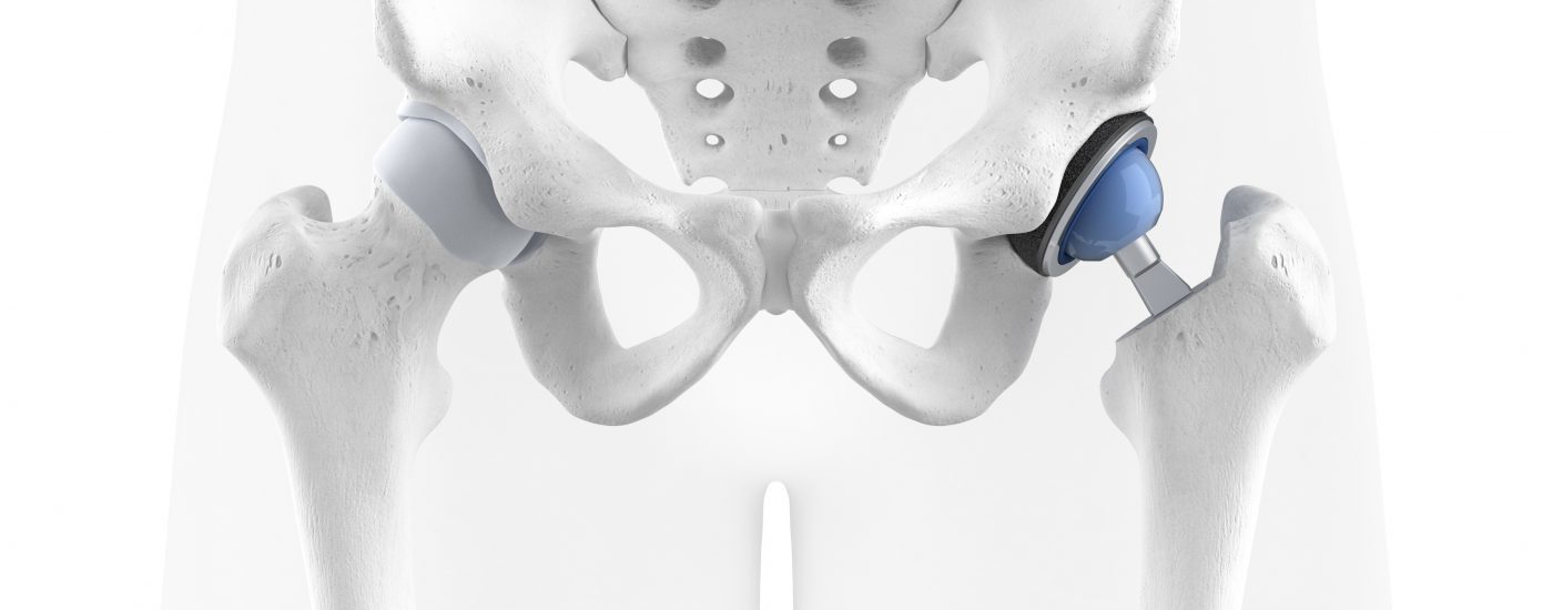 Hip prosthesis inside the patient