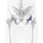 Hip prosthesis inside the patient